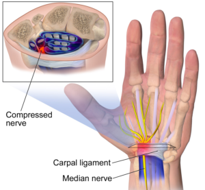 Carpal Tunnel Syndrome Treatment, Raleigh hand surgeon