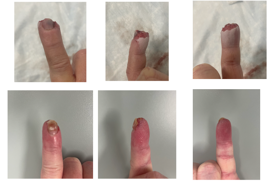 Finger tip amputation Raleigh hand surgeon Treatment