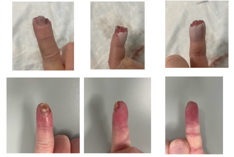 Finger Tip Amputation Treatment Raleigh Hand Surgeon