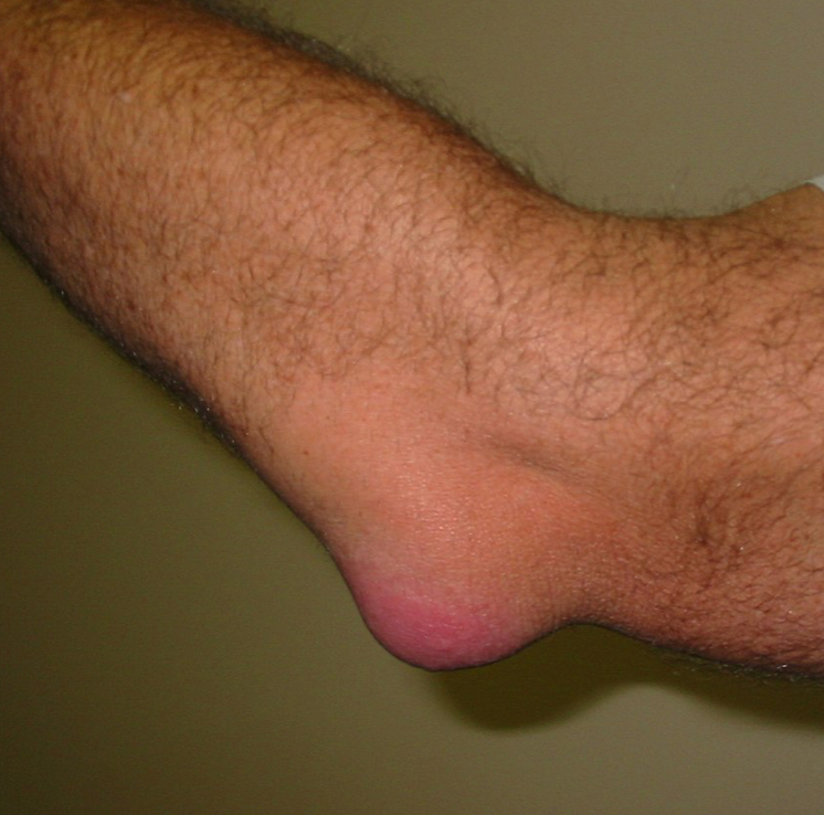 Gout Treatment in Raleigh , NC