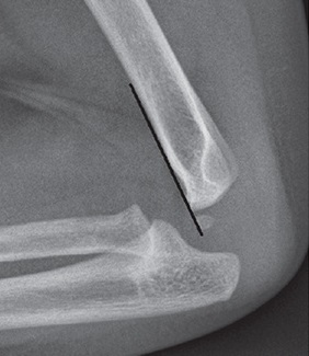 Supracondylar Humerus Fracture Treatment in Raleigh, NC