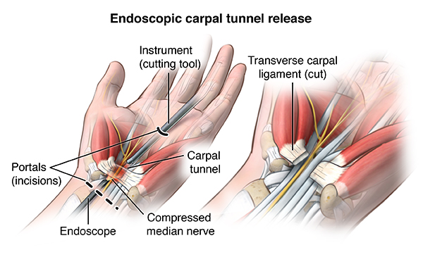 Endoscopic Carpal Tunnel Release in Raleigh, NC