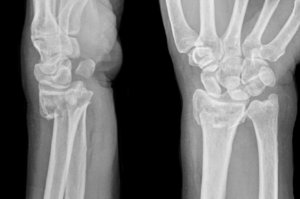 Distal radius fracture treatment in raleigh nc