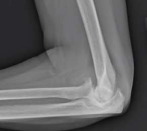 Elbow Arthritis Treatment in Raleigh NC