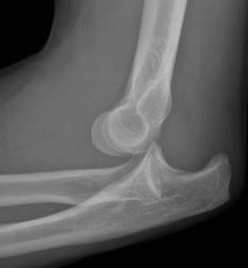 Elbow Dislocation Treatment in Raleigh, NC