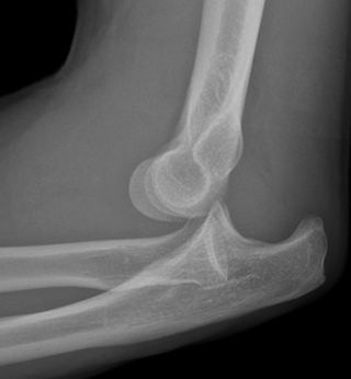 Elbow Dislocation Treatment in Raleigh, NC
