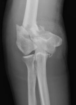 Elbow Fracture Treatment in Raleigh NC