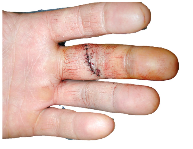 Flexor tendon injury treatment in Raleigh, NC