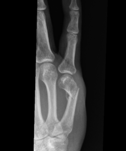Finger Fracture - Raleigh Hand Surgeon