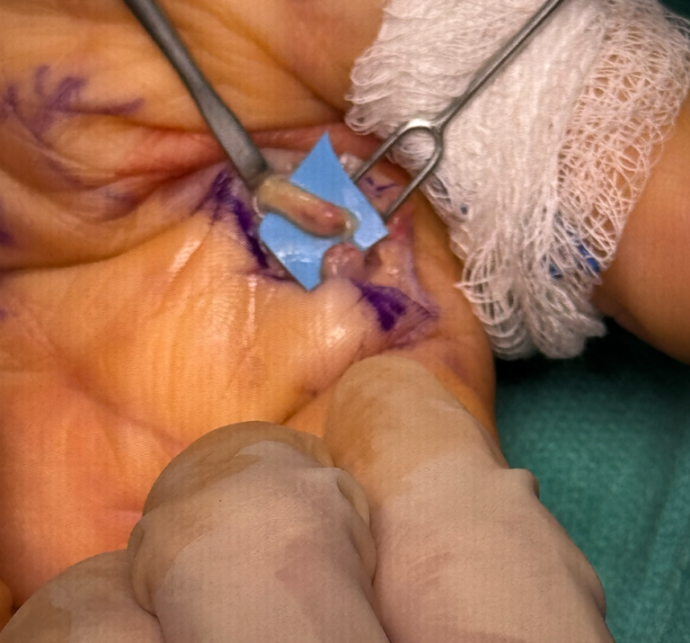 Finger Hand Nerve injury treatment in Raleigh, NC