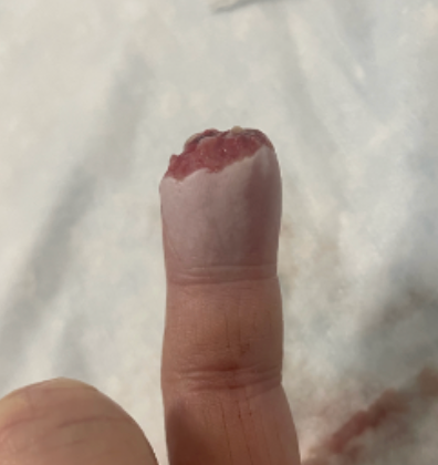 Finger amputation treatment in Raleigh, NC