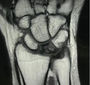 Keinbock Disease Treatment in Raleigh NC