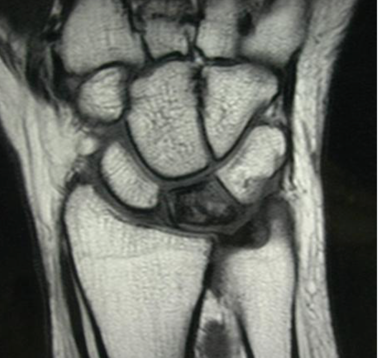 Keinbock Disease Treatment in Raleigh NC