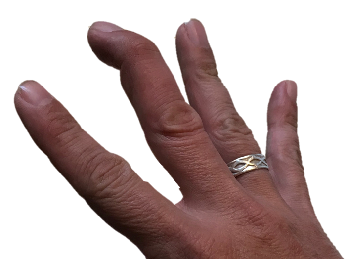 Mallet finger treatment in Raleigh, NC