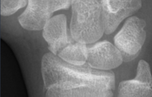 Scaphoid Treatment in Raleigh NC