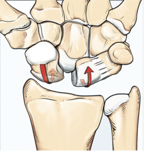 Scapholunate ligament injury treatment in Raleigh, NC