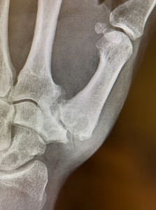 Thumb Arthritis treatment in Raleigh, NC