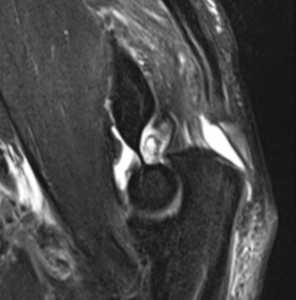 Triceps tendon rupture treatment in Raleigh, NC