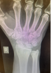 Wrist Arthrtis Treatment in Raleigh, NC