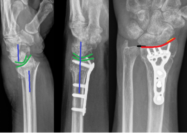 Wrist Fracture treatment in Raleigh NC