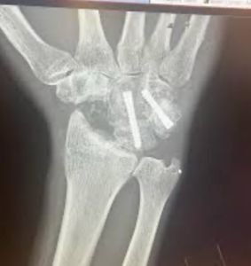 Wrist Surgery in Raleigh NC