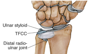 Wrist Sprain TFCC injuries in Raleigh NC