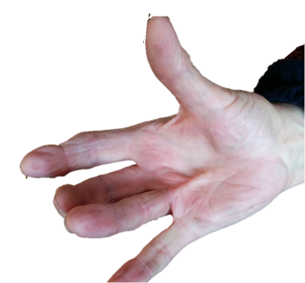 Dupuytren’s Disease