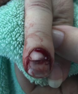 Pediatric Finger Injury in Raleigh NC