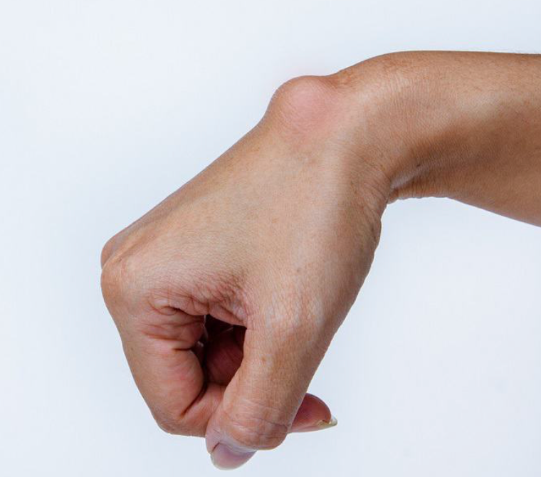 Ganglion Cyst treatment in Raleigh NC