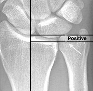 ulnar impaction syndrome raleigh, nc